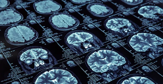 MRT Scan from a brain. Photo: Fotolia.com/Nomad_Soul.