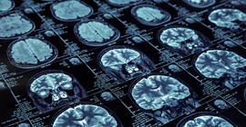 MRT Scan from a brain. Photo: Fotolia.com/Nomad_Soul.